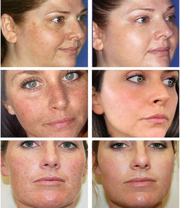 CLOVER Dark Spot/ Melasma Cream Remover Treatment - Bali Lumbung